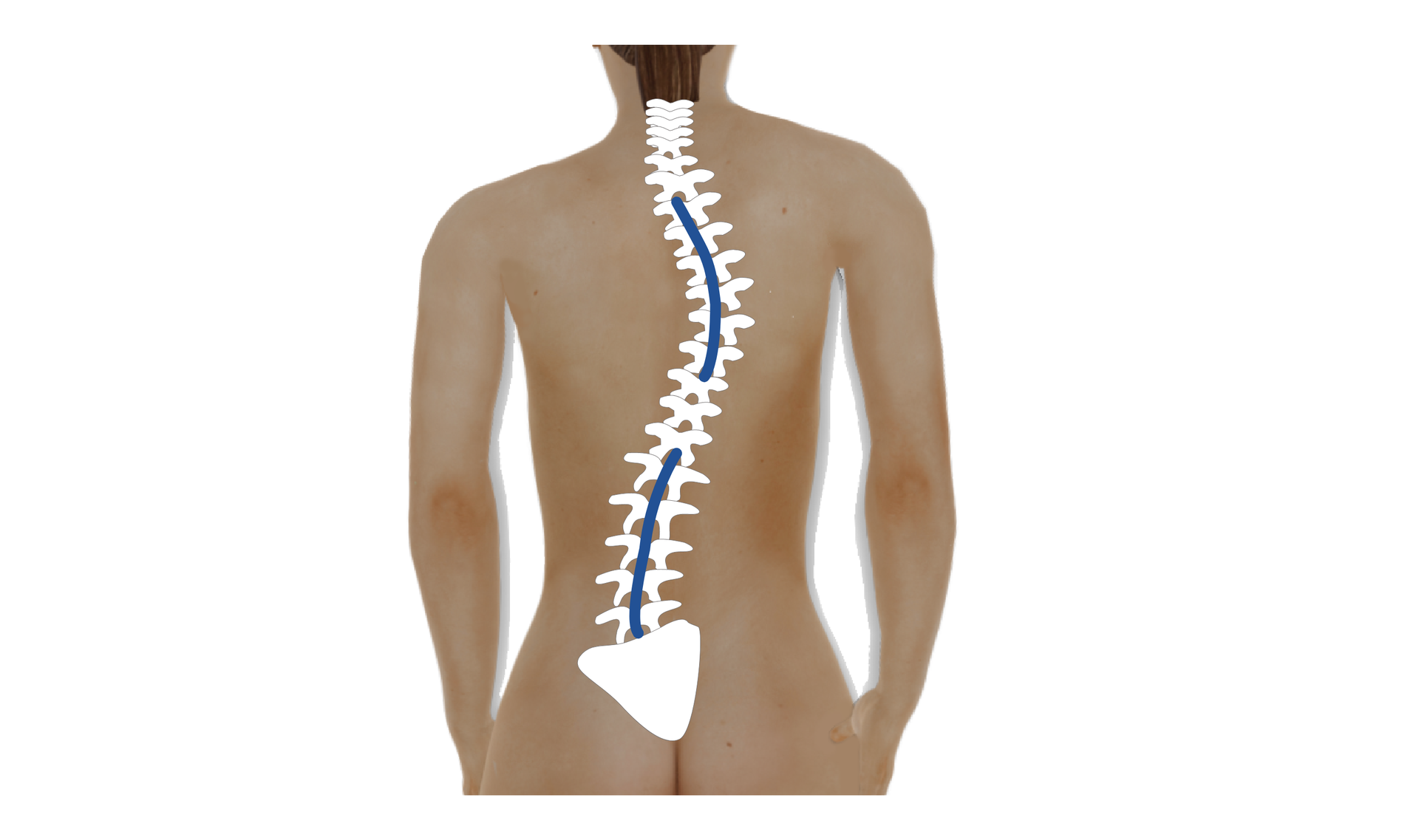 Grafika przedstawiająca ciało człowieka. Na rycinie zaznaczono kręgosłup ze skrzywieniem w odcinku piersiowym i lędźwiowym.