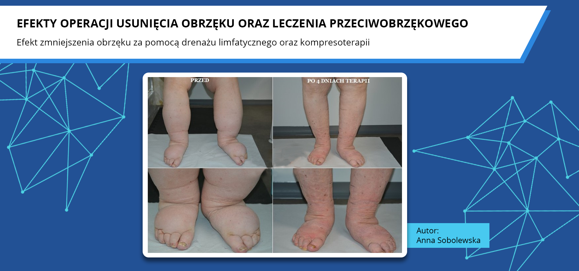 Zdjęcia pod tytułem efekty operacji usunięcia obrzęku oraz leczenia przeciwobrzękowego. Efekt zmniejszenia obrzęku za pomocą drenażu limfatycznego oraz kompresoterapii. Zdjęcia przedstawiają kończyny dolne przed terapią, znacznie opuchnięte na całej długości oraz kończyny dolne po czterech dniach terapii, zaczerwienione, ale bez widocznego obrzęku. Autorka zdjęć: Anna Sobolewska.