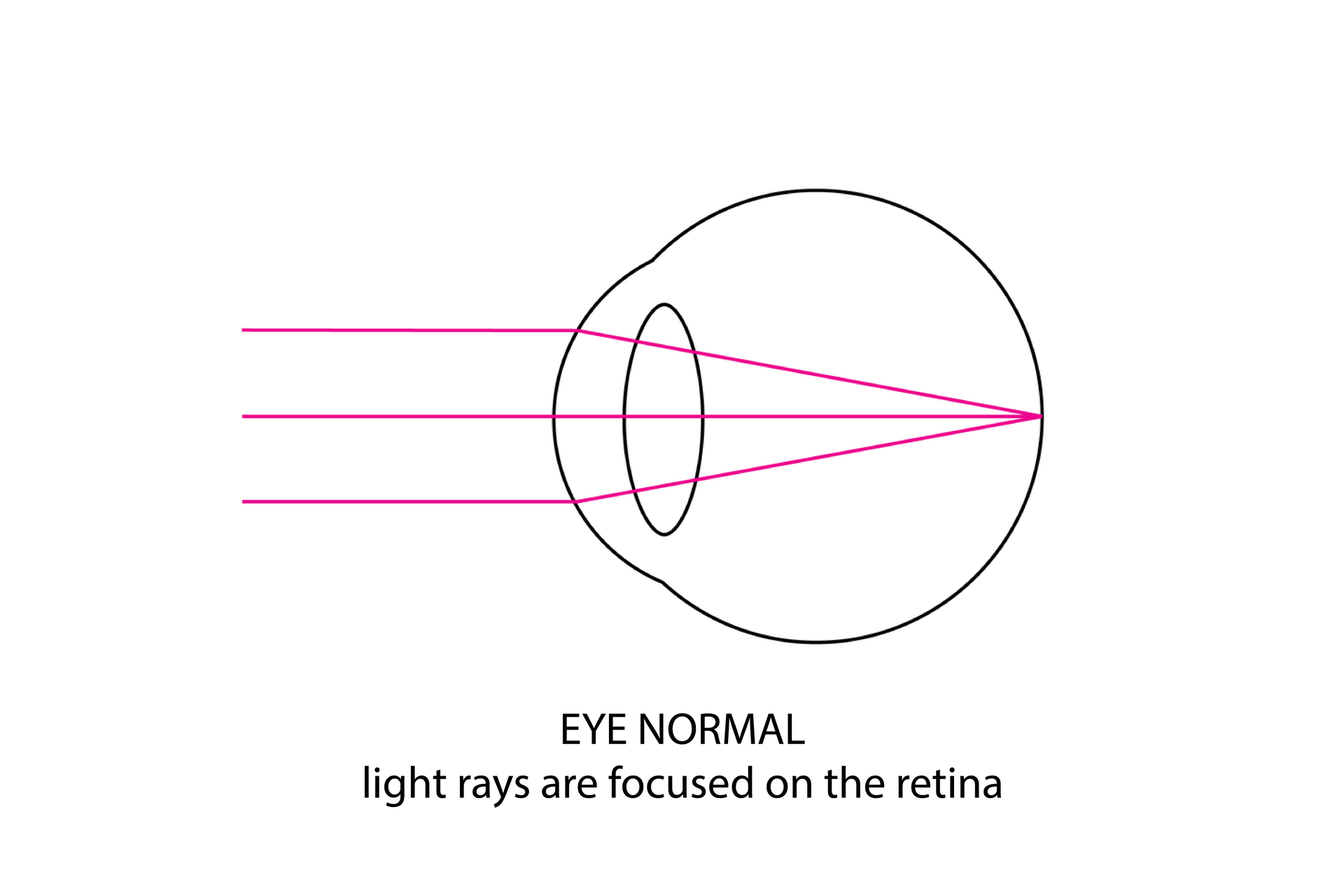 Ilustracja przedstawia oko normalne. Różowe promienie świetlne skupiają się na siatkówce. 