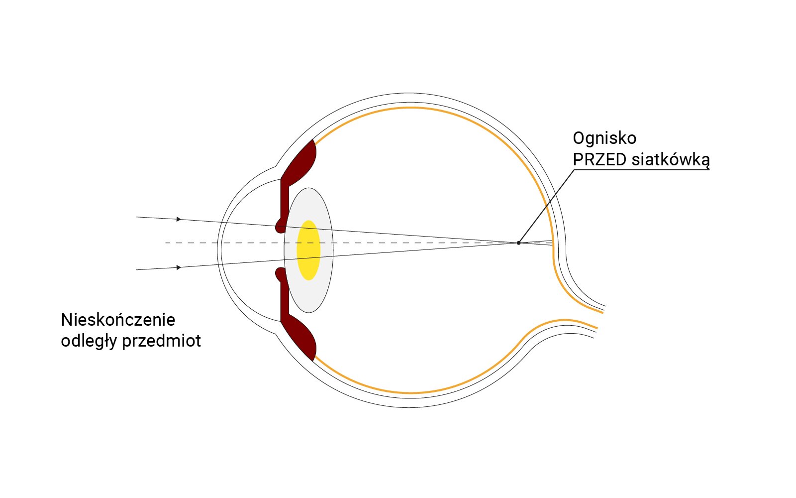Ilustracja przedstawia krótkowzroczność oka. Jest to wada polegająca na wyraźnym widzeniu przedmiotów znajdujących się blisko, podczas gdy przedmioty znajdujące się w oddali wydają się być zamazane.