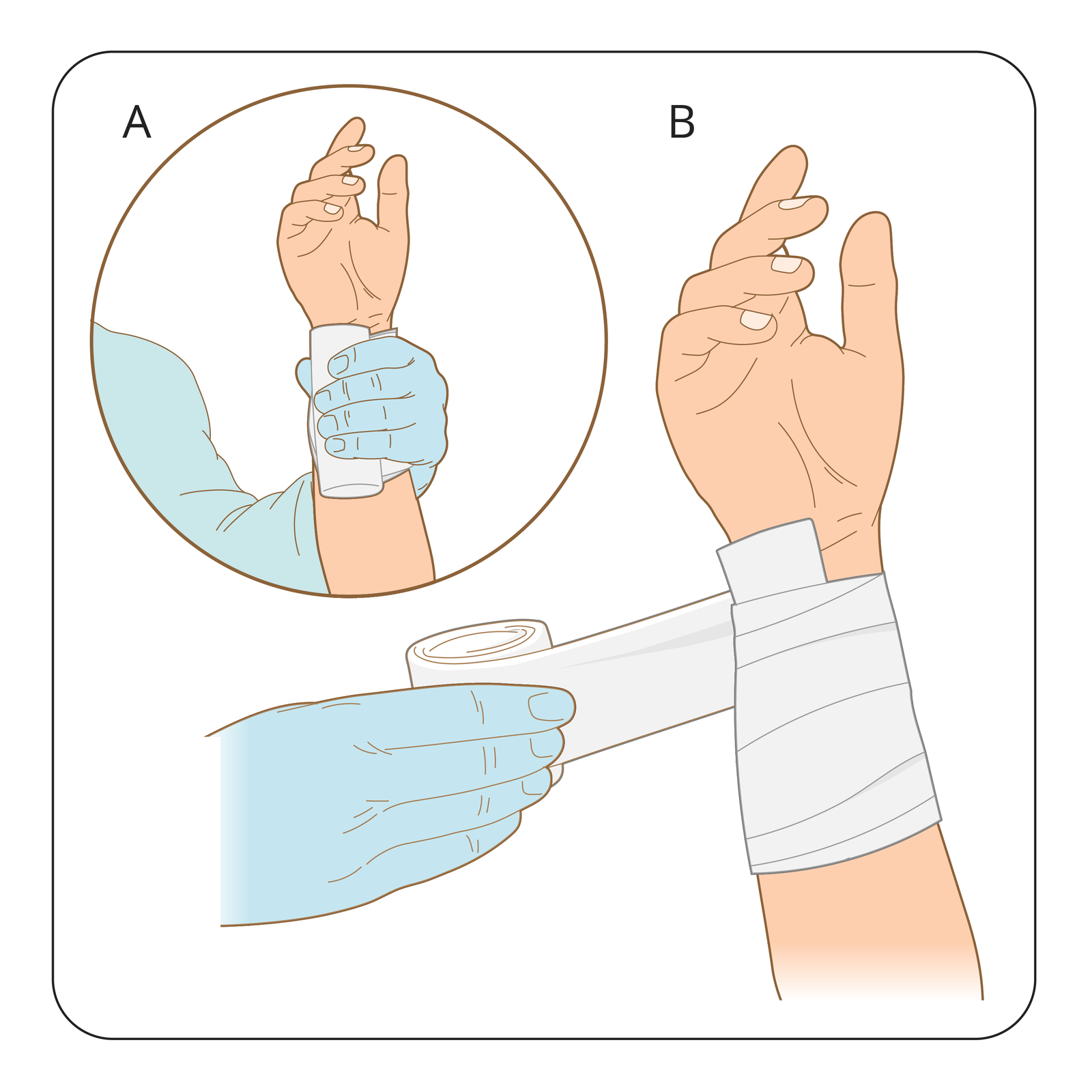Ilustracja przedstawia sposób bandażowania zranionego miejsca z opatrunkiem i składa się z dwóch elementów: mniejszego A stanowiącego kolisty wycinek z obrazkiem zajmujący lewy górny róg kadru i większego B zajmującego pozostały obszar rysunku. Na obydwu rysunkach prawa ręka poszkodowanego uniesiona w górę, wnętrze otwartej dłoni skierowane w stronę obserwatora. W części A lewa dłoń sanitariusza w gumowej rękawiczce przytrzymuje zwinięty bandaż w miejscu zranienia na przyłożonym wcześniej opatrunku z gazy. W części B ten sam bandaż owinięty jest już spiralnie wokół miejsca zranienia. Ręka poszkodowanego nadal uniesiona pionowo. Zwinięty koniec bandaża przytrzymuje dłonią sanitariusz.