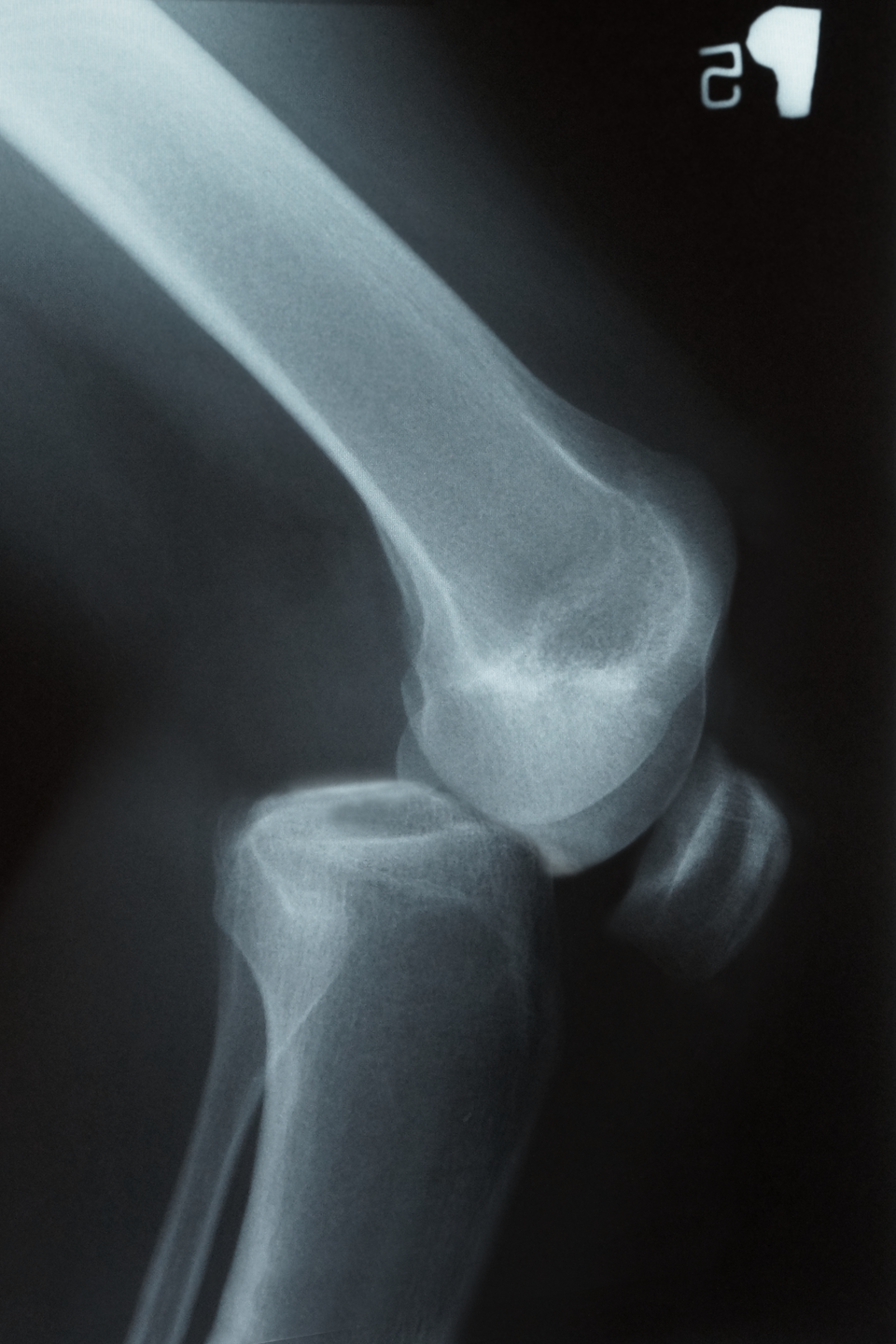 Galeria przedstawia przykłady zwichnięć kończyn. Trzecie zdjęcie prezentuje czarnobiały obraz z kliszy rentgenowskiej. Dwie kości przemieszczone względem siebie. Staw górnej kości jest przemieszczony i wsparty na dolnej kości w nieprawidłowy sposób.