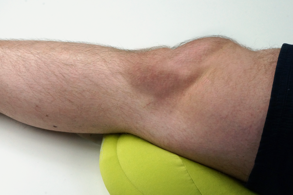 Galeria przedstawia przykłady zwichnięć kończyn. Drugie zdjęcie prezentuje nogę od połowy łydki do połowy uda wspartą na poduszce. Kolano ma nieprawidłowy obrys - z prawej strony jest wyższe niż powinno i opuchnięte.