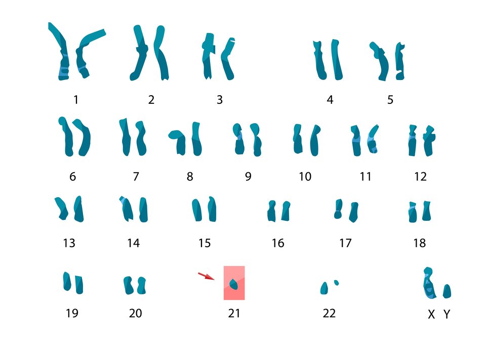 Monosomia chromosomu 21. Na ilustracji są 23 pary chromosomów. Zamiast 21. pary chromosomów jest tylko jeden chromosom. Największa jest para pierwsza i druga, najmniejsza 21. 23 para chromosomów to XY. 