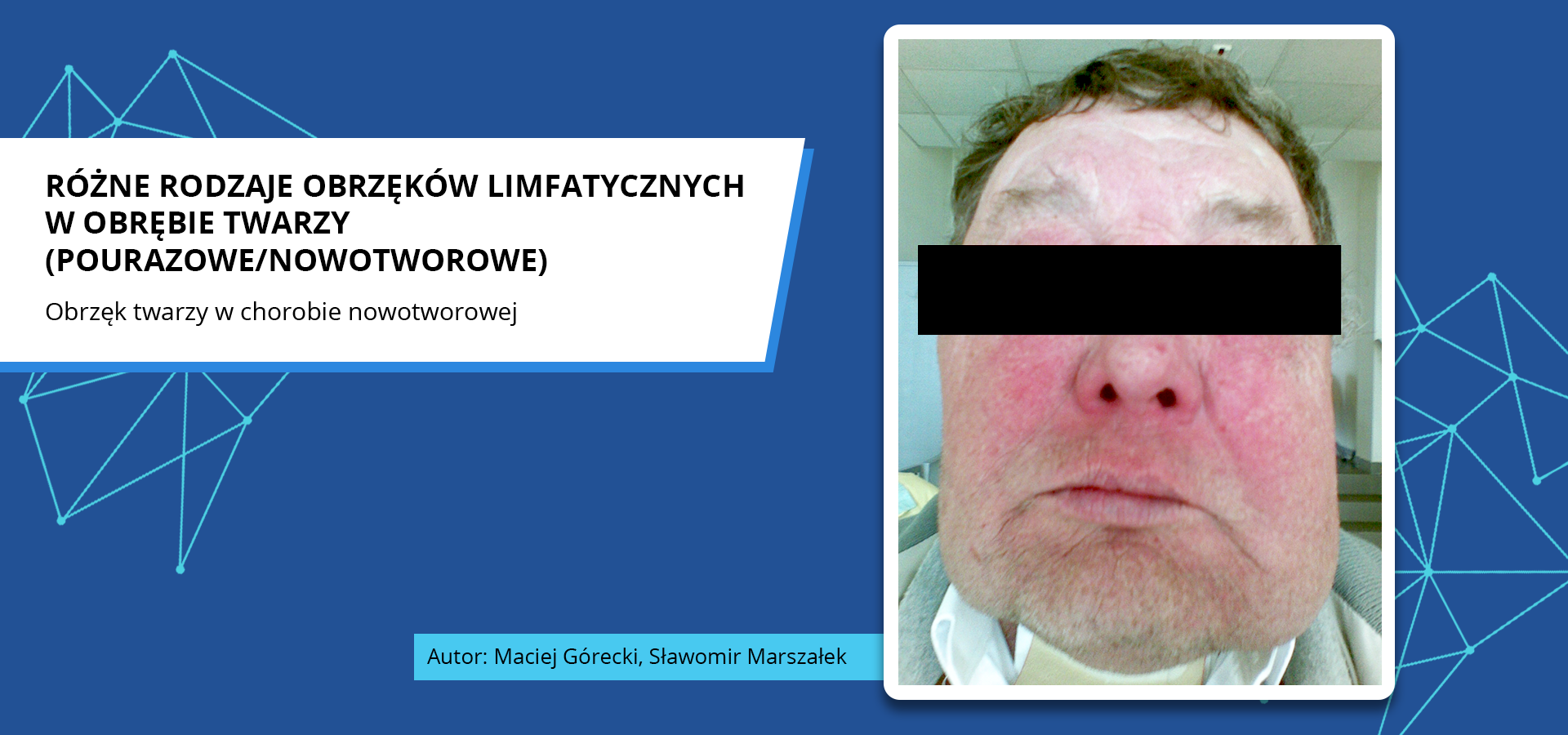 Zdjęcie o tytule różne rodzaje obrzęków limfatycznych w obrębie twarzy, pourazowe lub nowotworowe. Obrzęk twarzy w chorobie nowotworowej. Zdjęcie przedstawia opuchniętą i zaczerwienioną w dolnej części twarz pacjenta. Autorzy zdjęcia: Maciej Górecki, Sławomir Marszałek.