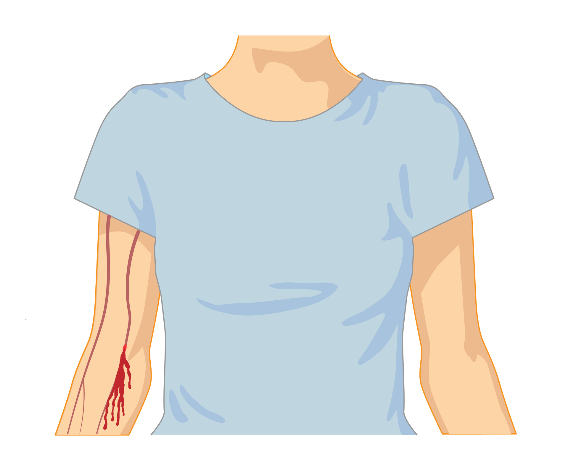Ilustracja przedstawiająca cechy charakterystyczne krwotoków żylnych i tętniczych. Osoba od szyi do pasa ubrana w t‑shirt stojąca przodem do obserwatora. Na ilustracji krwotok żylny. Na ręce po lewej stronie dwie ciemnoczerwone pionowe linie, ułożone równolegle do siebie, z których lewa rozwidla się w dolnej części. Przedstawiają one żyły. W zgięciu ręki pod łokciem z żyły po prawej stronie wycieka krew i spływa strumieniem wzdłuż przedramienia.