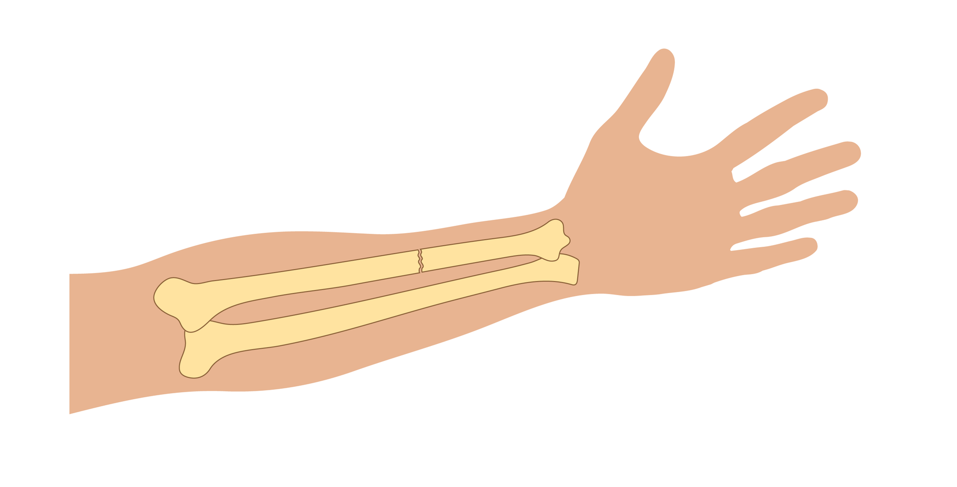 Ilustracja przedstawia zarys przedramienia prawej ręki skierowany wyprostowanymi palcami w prawą stronę. Na ilustrację naniesiono schematyczne rysunki kości przedramienia ułożone równolegle do siebie. Przykład przedstawia złamanie przebiegające w poprzek górnej kości.