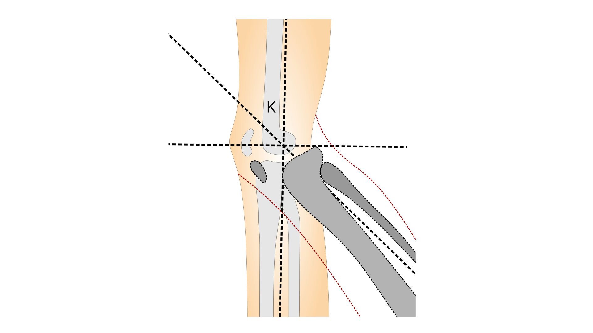 Rycina przedstawia schemat budowy kostnej stawu kolanowego od boku. Literą K oznaczona jest pionowa linia osi wyprostowanego stawu kolanowego. Ciemniejszym kolorem zaznaczono kości goleni w zgięciu stawu kolanowego, z linią przechodzącą w ich osi pionowej. W ten sposób zwizualizowano kąt zgięcia stawu o mniej więcej 45 stopni.