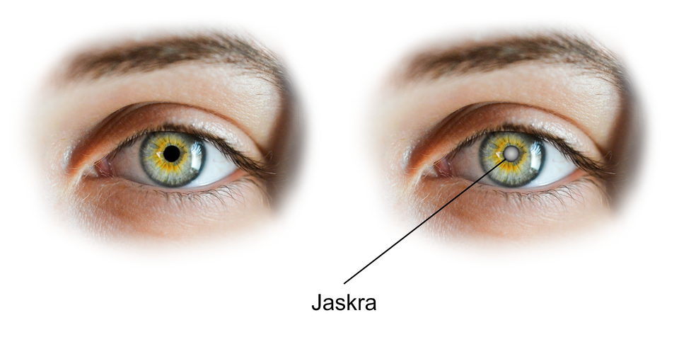 Ilustracja przedstawia zdrowe oko (źrenica jest czarna) oraz drugie oko z jaskrą (źrenica jest biała). 