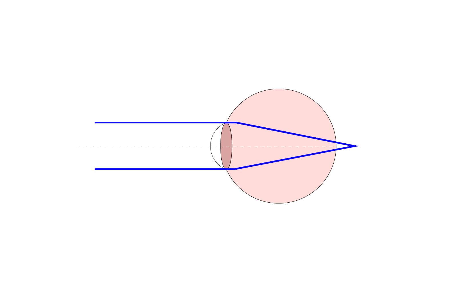 Ilustracja przedstawia nadwzroczność oka pokazane jest oko oraz nieprawidłowe ogniskowanie światła na siatkówce oka. Do ogniskowania dochodzi poza okiem.