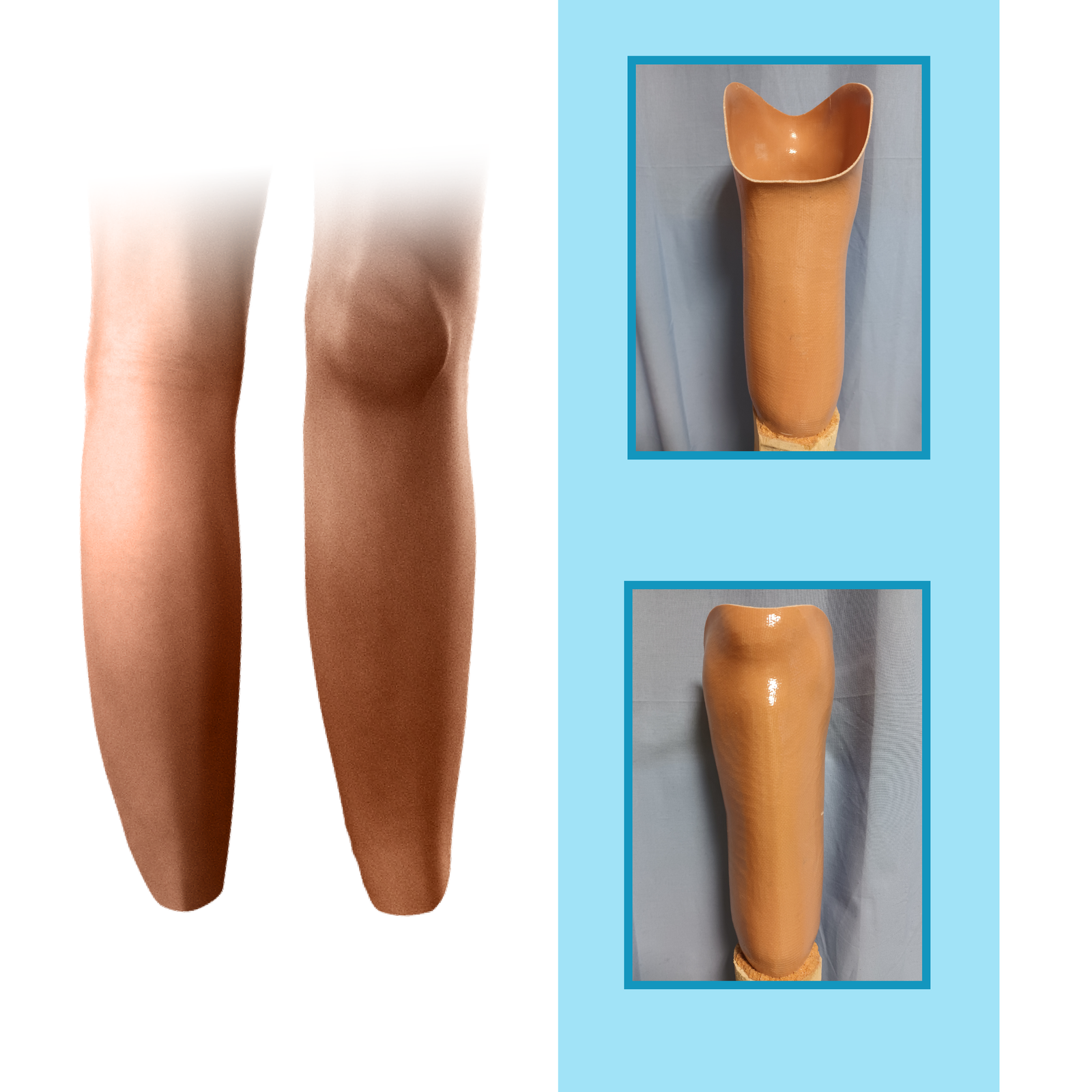 Grafika przedstawia długi kikut podudzia w widoku z przodu i z tyłu. Na rycinie zamieszczono również zdjęcia leja typu KBM w widoku z przodu i z tyłu. Lej został wykonany z tworzywa sztucznego.