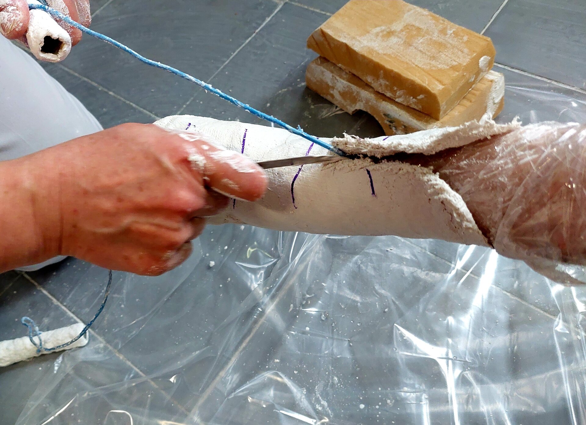 Zdjęcie przedstawia rozcinanie formy gipsowej w celu ściągnięcia jej ze stopy.