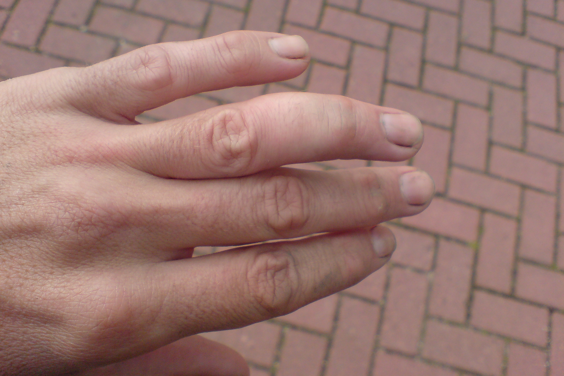 Zdjęcie prezentuje lewą dłoń widzianą z góry. Palce wyprostowane, palec serdeczny wygięty pod nienaturalnym kątem i wyraźnie opuchnięty powyżej stawu.