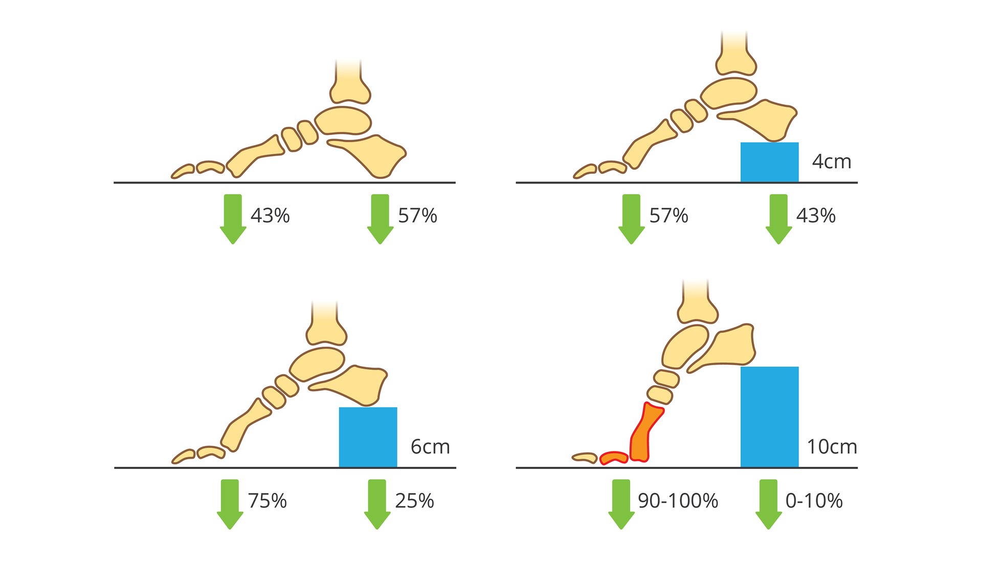 Ilustracja przedstawia 4 rysunki kości stopy w kolorze morelowym, z boku, na poziomej kresce. Na niebiesko zaznaczono obcasy o różnej wysokości i układ kości w butach na takim obcasie. Pierwsza z lewej u góry stopa bez obcasa. Zielone strzałki wskazują procentowe rozłożenie ciężaru ciała na pierwszą kość śródstopia (43 procent) i kość piętową (57 procent). Z prawej stopa na obcasie o wysokości 4 centymetrów. Kość śródstopia obciążona w pięćdziesięciu siedmiu procentach, kość piętowa w czterdziestu trzech procentach. U dołu na obcasie sześciocentymetrowym kość śródstopia obciążona w siedemdziesięciu pięciu procentach, pięta w dwudziestu pięciu procentach. Na obcasie o wysokości 10 centymetrów kość śródstopia dźwiga 90 do 100 procent ciężaru ciała. Zaznaczono to kolorem ciemnopomarańczowym.