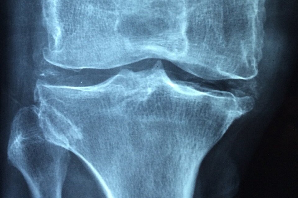 Ilustracja przedstawia zdjęcie rentgenowskie stawu łokciowego człowieka. 