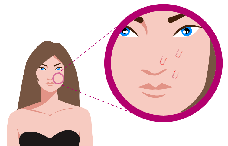 Grafika przedstawia kobietę wraz ze zbliżeniem na twarz. Na skórze twarzy obok nosa i pod okiem widoczne uszkodzenia będące wynikiem agresywnego działania łyżeczką Unny.