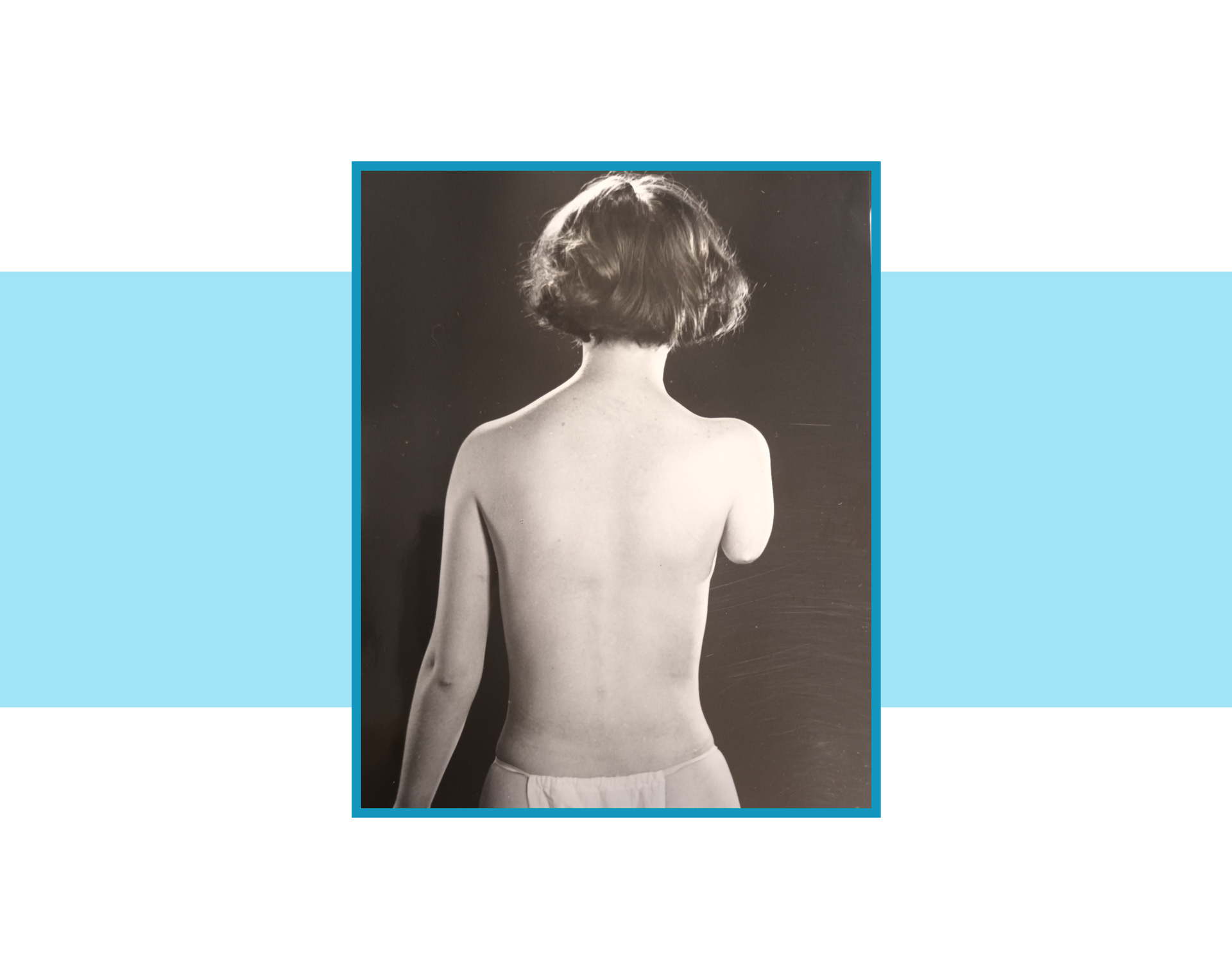 Zdjęcie kobiety z krótkim kikutem prawego ramienia.