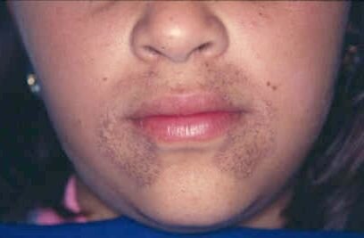 Zdjęcie przedstawia zbliżenie na dolną część twarzy kobiety. Wokół jej górnej wargi i boków dolnej wargi znajdują się ciemne, drobne plamy.