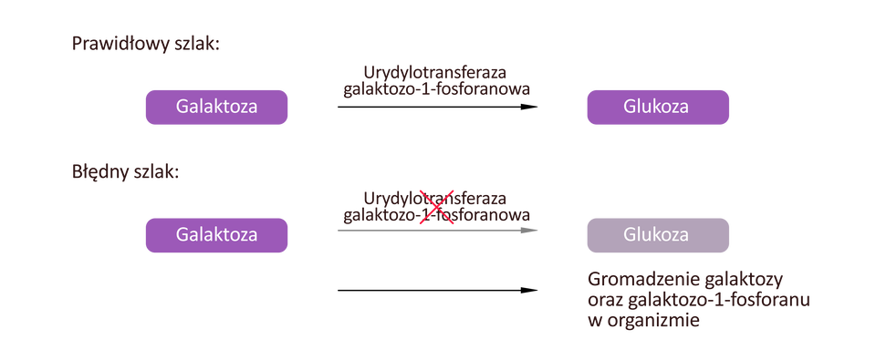 Ilustracja przedstawia dwa schematy. Pierwszy schemat ma podpis „Prawidłowy szlak”. Na schemacie mamy po lewej stronie hasło Galaktoza, od którego prowadzi w prawo strzałka z napisem Urydylotansferaza do hasła Glukoza. Drugi schemat ma podpis „Błędny szlak”. Na schemacie mamy po lewej stronie hasło Galaktoza, od którego prowadzi w prawo przekreślona strzałka z napisem Urydylotansferaza do hasła Glukoza. Pod spodem znajduje się druga strzałka i napis Gromadzenie galaktozy oraz galaktozo‑1-fosforanu w organizmie.
