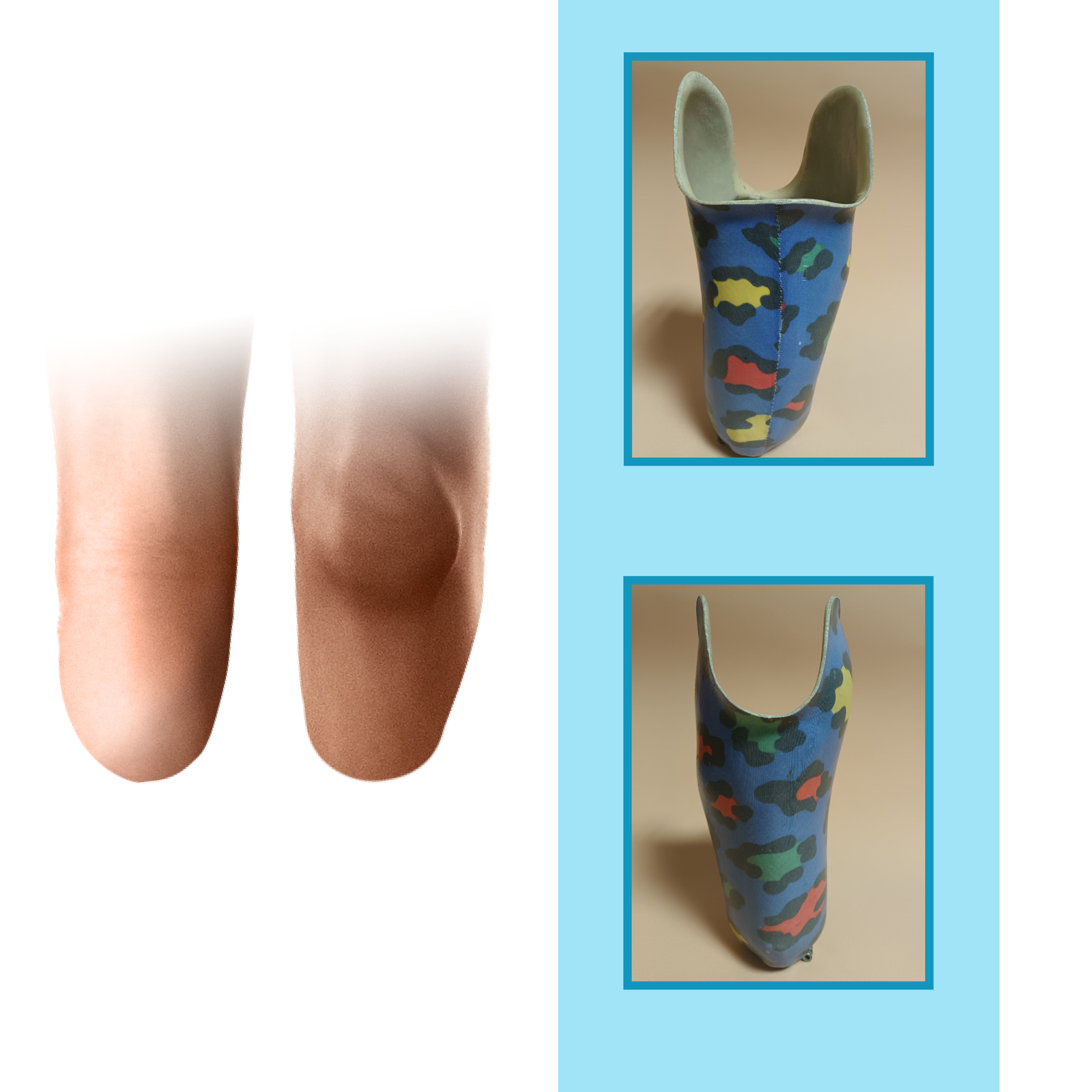 Grafika przedstawia krótki kikut podudzia w widoku z przodu i z tyłu. Na rycinie zamieszczono również zdjęcia leja typu KBM w widoku z przodu i z tyłu. Lej został wykonany z kolorowego tworzywa sztucznego.