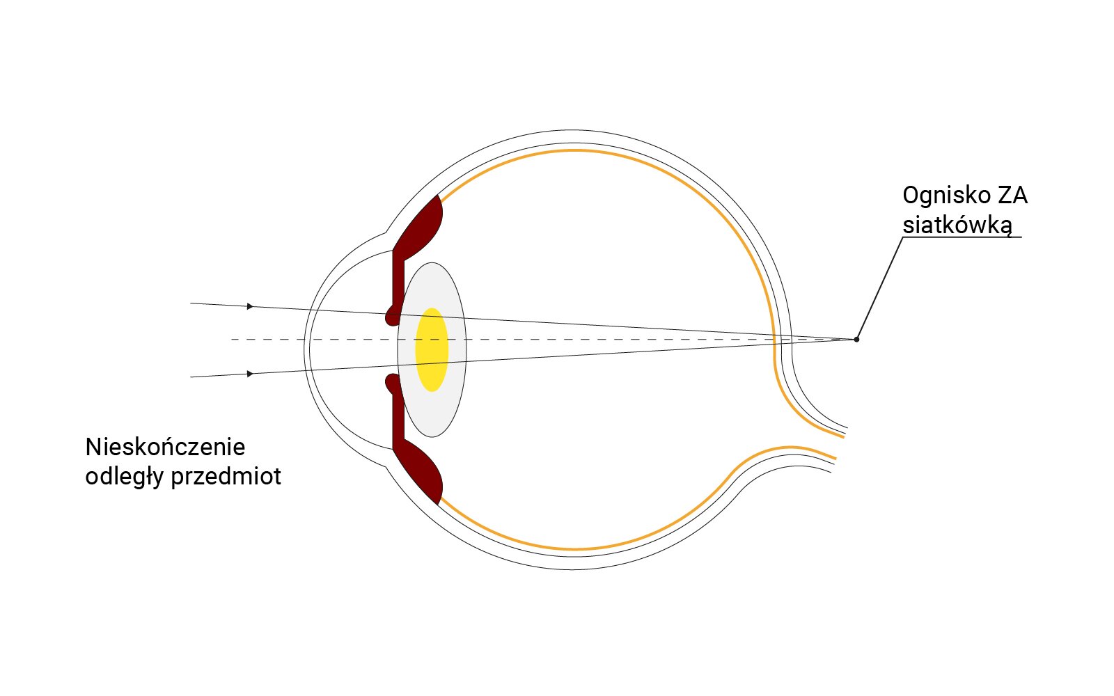 Ilustracja przedstawia schemat nadwzroczności oka jest to wada która powoduje niewyraźne widzenie szczególnie z bliska, ale także z daleka. Jego przyczyną jest nieprawidłowe ogniskowanie promieni świetlnych przez układ optyczny oka za siatkówką, przez co do mózgu dociera rozmyty obraz.