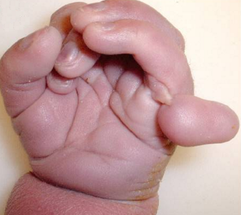 Fotografia przedstawia rączkę dziecka z zespołem Pataua. Charakteryzuje się polidaktylią, czyli dodatkowym, zniekształconym palcem, który wyrasta z boku dłoni, 