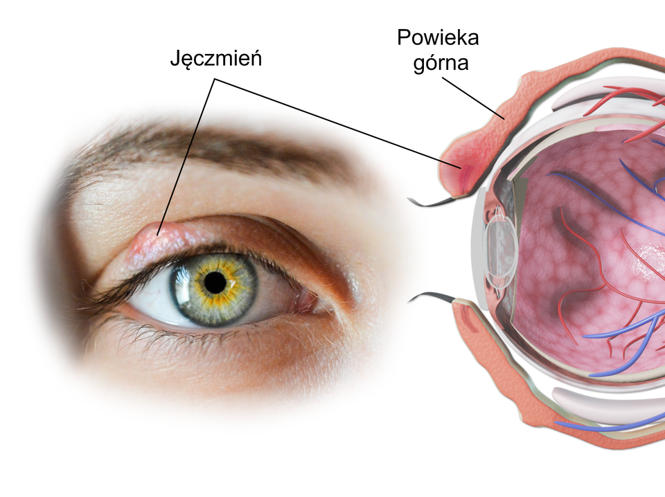 Ilustracja przedstawia ludzkie oko oraz obraz anatomiczny gałki ocznej. Na górnej powiece widać czerwone wybrzuszenie. To jęczmień. W wersji anatomicznej znajduje się ono tuż nad rzęsami na górnej powiece.  