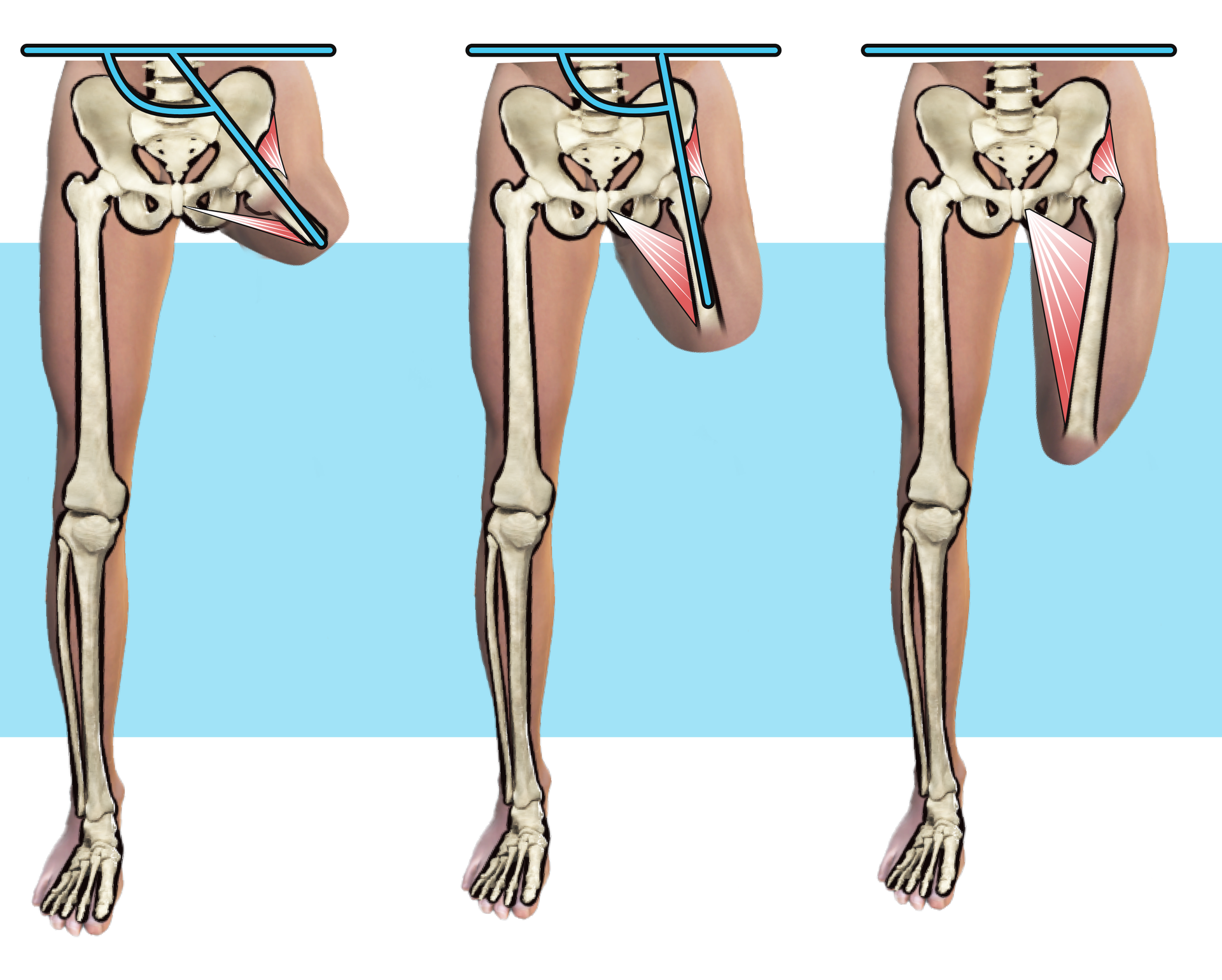 Grafika przedstawia schemat krótkiego, średniego i długiego kikuta uda. Na rycinie zaznaczono mięśnie oddziałujące na poszczególne kikuty. Im dłuższy kikut, tym większe oddziaływanie na niego mięśnia z przyczepem na kości kulszowej, skutkujące bardziej przyśrodkowym ustawieniem.
