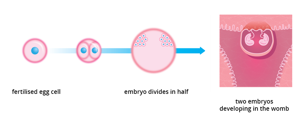 Ilustracja przestawia schemat rozwoju ciąży bliźniaczej jednojajowej. Z lewej różowa komórka jajowa z błękitnym jądrem. Strzałka prowadzi do koła, oznaczającego zarodek, z dwoma takimi komórkami. Kolejne różowe koło z dwoma skupieniami komórek u góry oznacza rozwój dwóch zarodków, powstałych z podziału zygoty na dwie części. Na końcu ukazano schematycznie, że w macicy w jednym jaju płodowym rozwijają się dwa identyczne genetycznie zarodki. Podpisano: fertilised egg cell; embryo divides in half; two embryos developing in the womb
