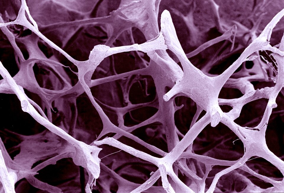 Zdjęcie mikroskopowe przedstawia przekrój przez kość osoby chorej na osteoporozę. Widoczne są cienkie jak patyczki struktury kostne. Niektóre z nich kończą się pęknięciem, po którym następuje brak struktury. Pomiędzy beleczkami są bardzo duże puste przestrzenie.