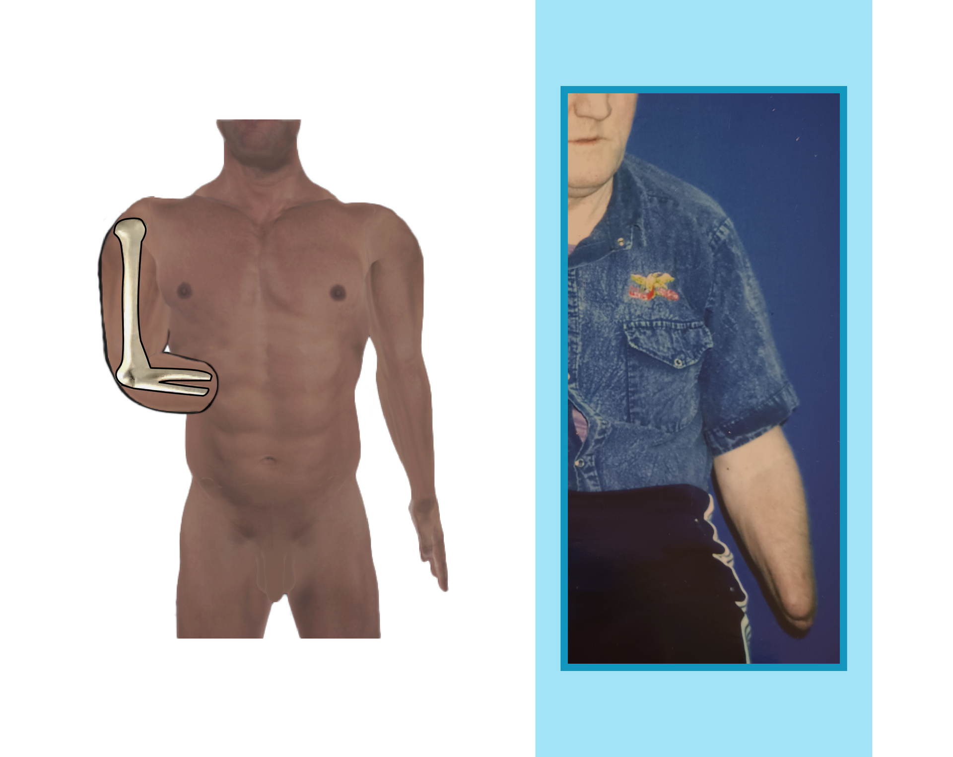 Grafika i zdjęcie przedstawiające pacjenta z krótkim kikutem przedramienia. 
