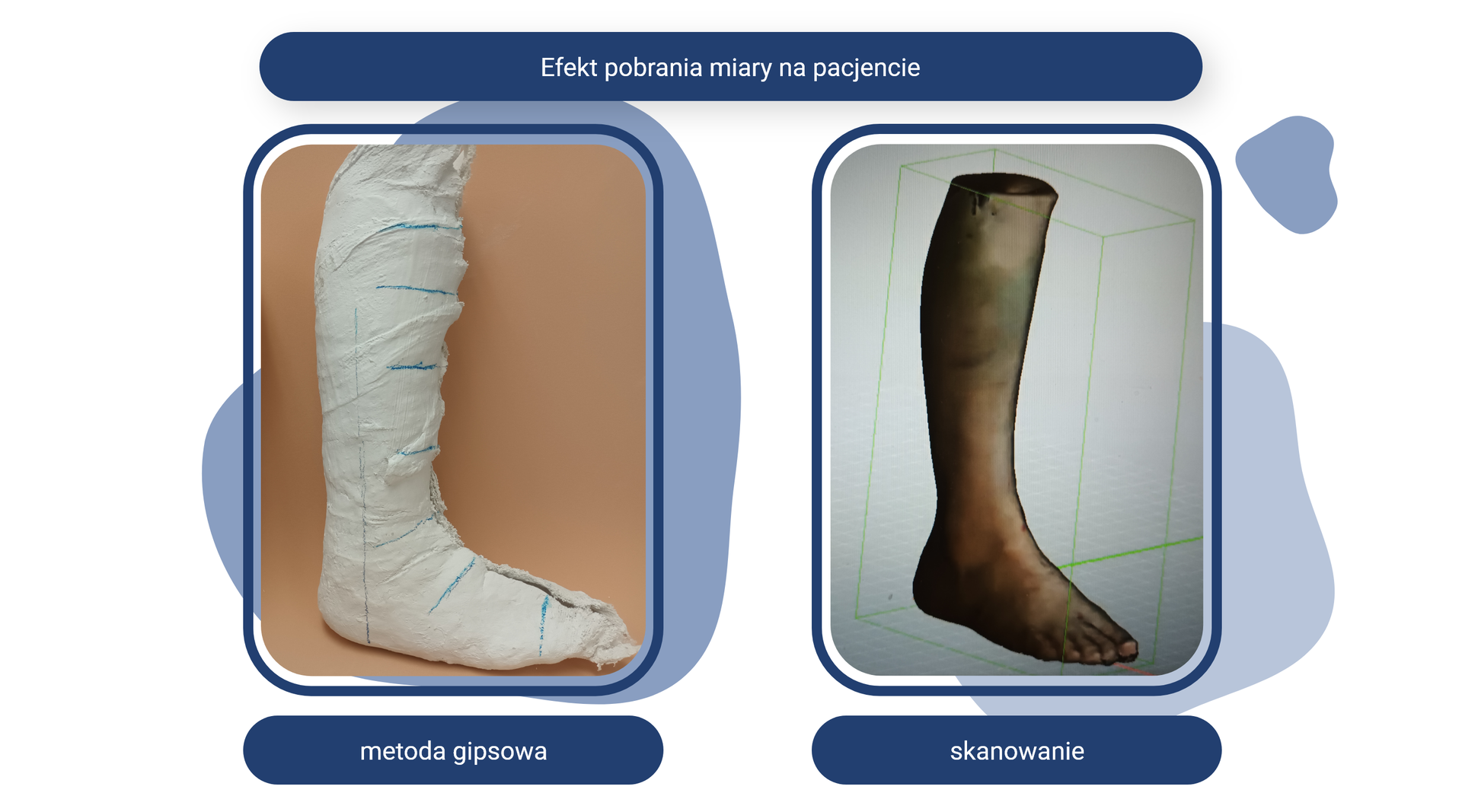 Plansza pod tytułem: Efekt pobrania miary na pacjencie. Na planszy znajdują się dwa zdjęcia z podpisami. 
Zdjęcie opisane jako metoda gipsowa przedstawia utwardzone opaski gipsowe z zaznaczonymi miejscami, w których dokonano pomiaru, kierując się od palców stopy do stawu kolanowego. 
Zdjęcie opisane jako skanowanie przedstawia model komputerowy 3D nogi od stopy po staw kolanowy. 
