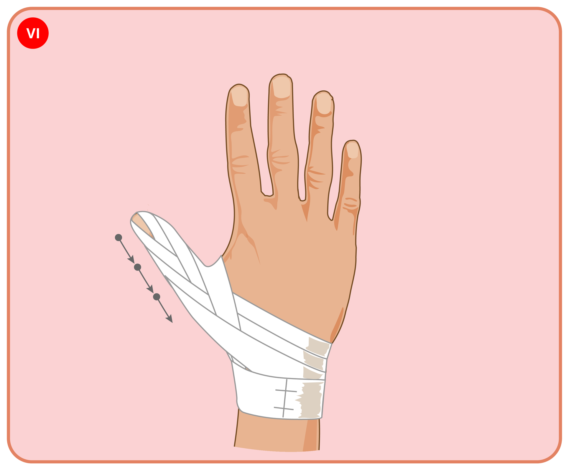 Fotografia przedstawia prawidłowo wykonany opatrunek techniką kłosowania