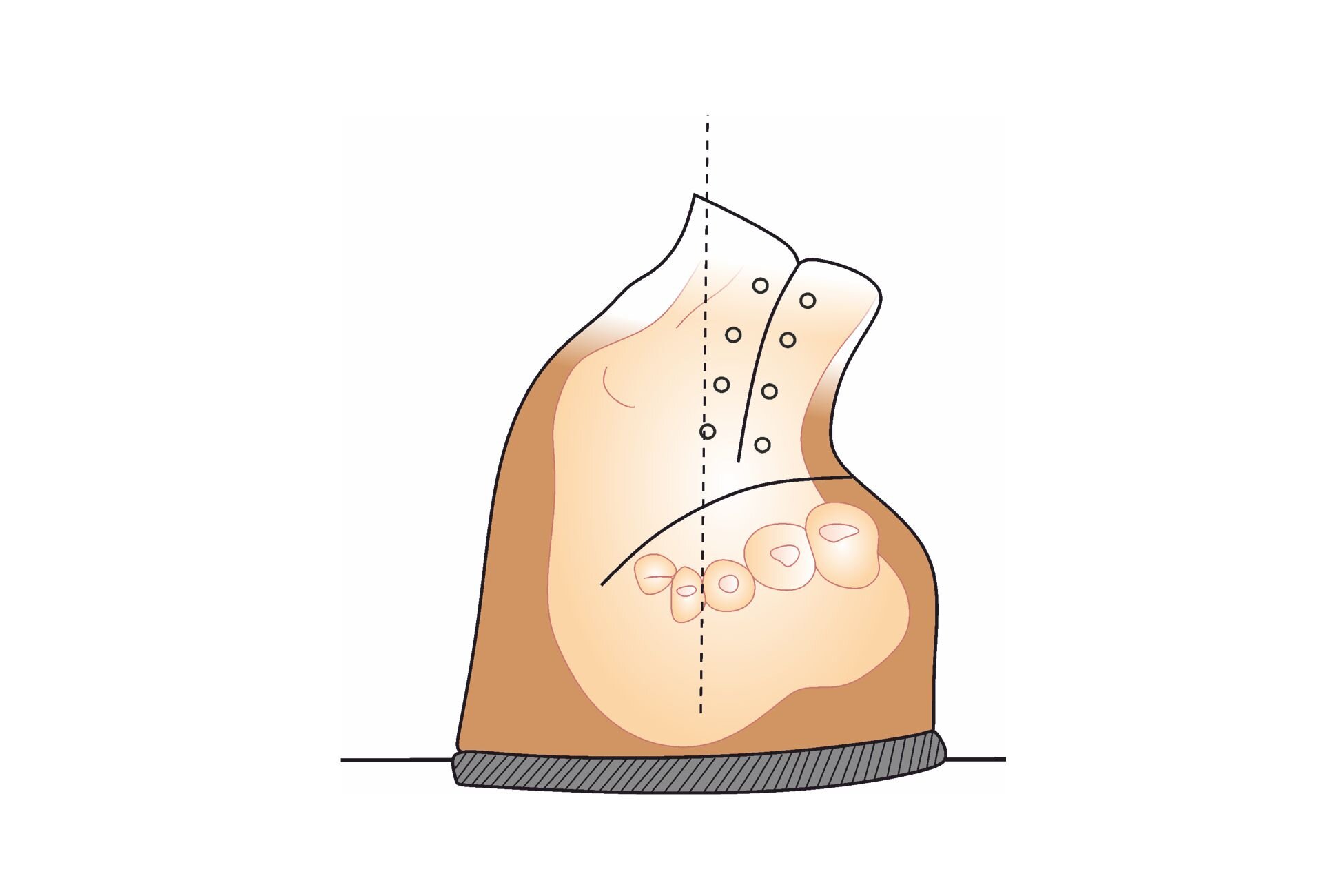 Grafika przedstawia stopę końsko szpotawą, ukształtowaną w obuwiu ortopedycznym, widzianą z przodu.