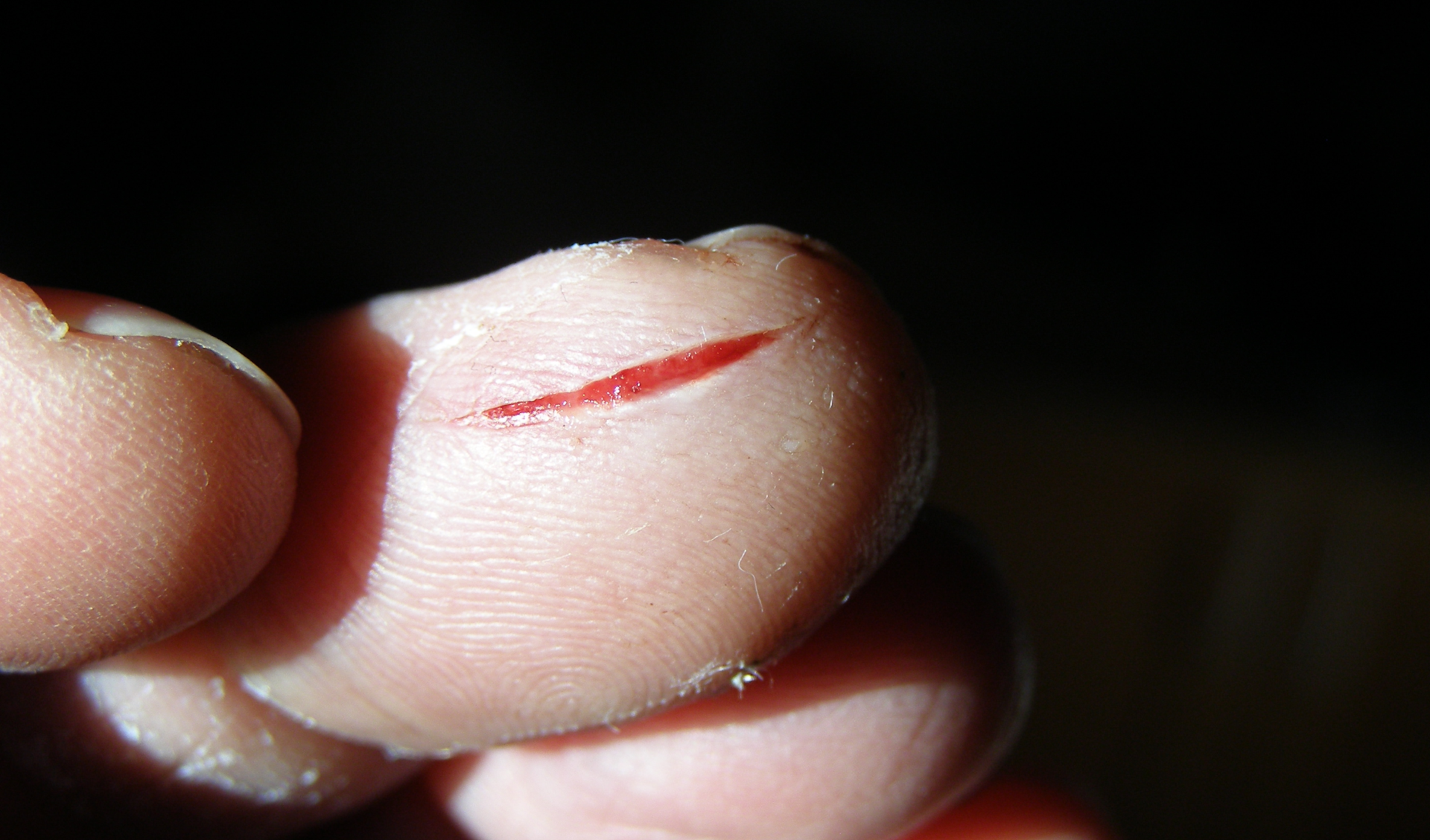 Fotografia przedstawia ranę na palcu. Skaleczenie jest głębokie. Przez rozcięty naskórek widać mięsień . Rana nie jest mocno krwawiąca.