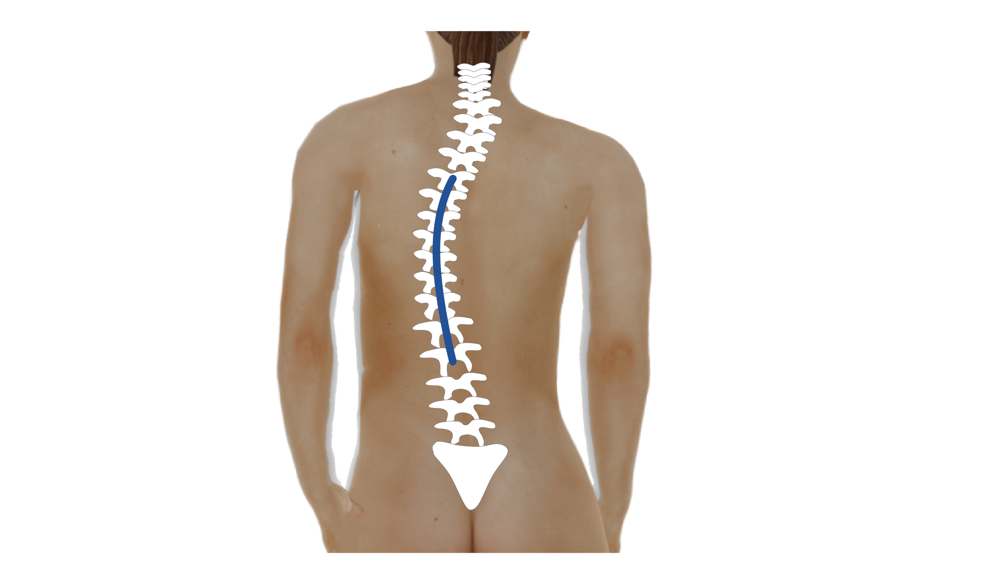Grafika przedstawiająca ciało człowieka. Na rycinie zaznaczono kręgosłup ze skrzywieniem w odcinku piersiowym i lędźwiowym.

