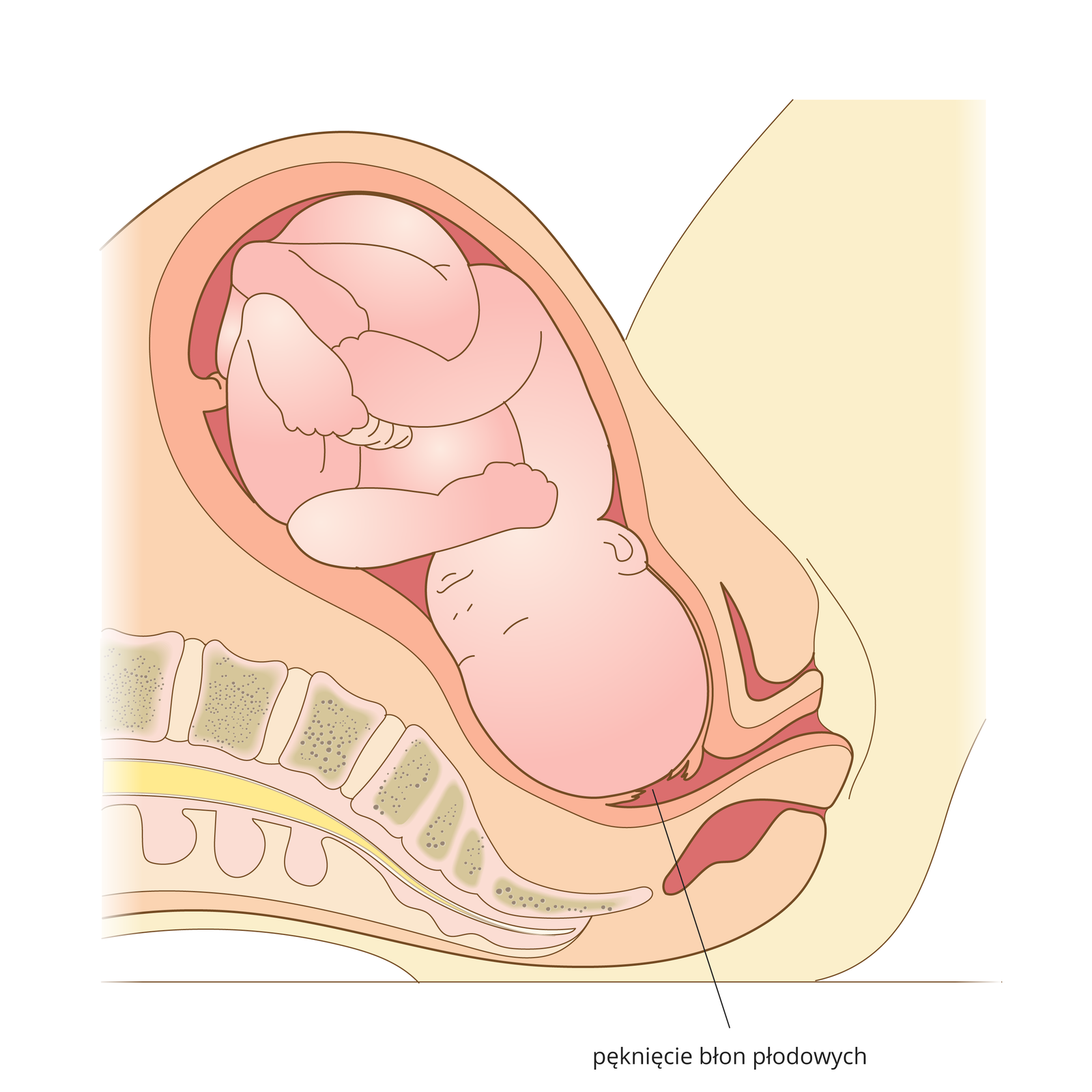 Ilustracja przedstawia drugą fazę porodu. Głowa dziecka przesunęła się w stronę pochwy w kanale rodnym, pękły błony płodowe.