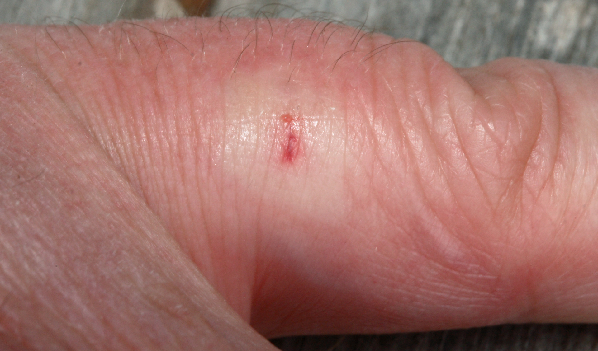 Fotografia przedstawia ukąszenie lub użądlenie w przybliżeniu, po wewnętrznej stronie palca. Ukąszenie spowodowało na skórze jasną plamkę o nieregularnym okrągłym kształcie. W środku plamki widoczna jest pionowa, krótka rana.