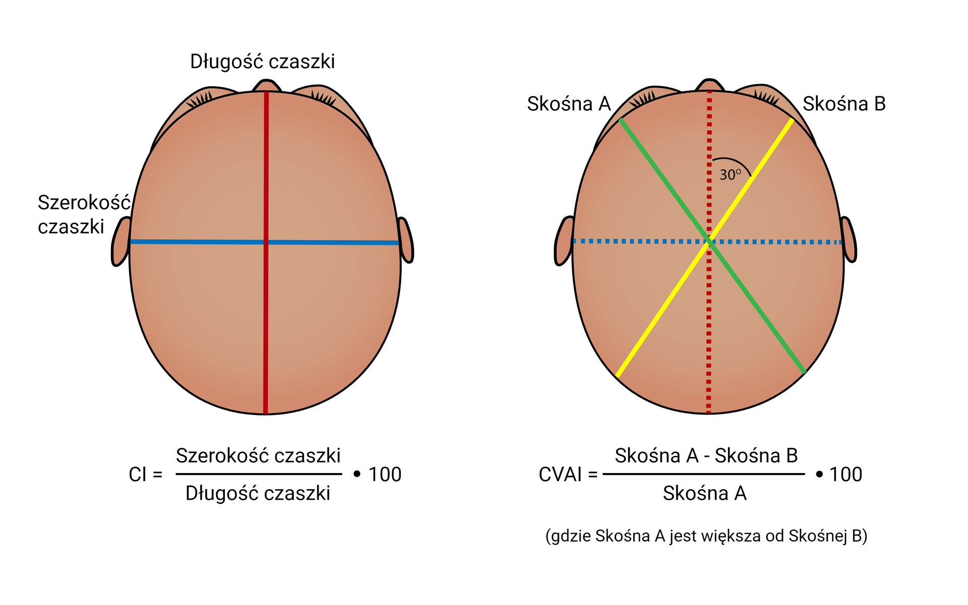 Grafika przedstawiająca odległości wymiarów czaszki: długość, szerokość, skośną A i skośną B. Na rycinie zamieszczono wzory, za pomocą których oblicza się wskaźnik cefaliczny (szerokość czaszki przez długość czaszki razy sto) oraz wskaźnik asymetrii sklepienia czaszki (skośna A minus skośna B podzielić przez skośną A razy sto, gdzie skośna A jest większa od skośnej B).
