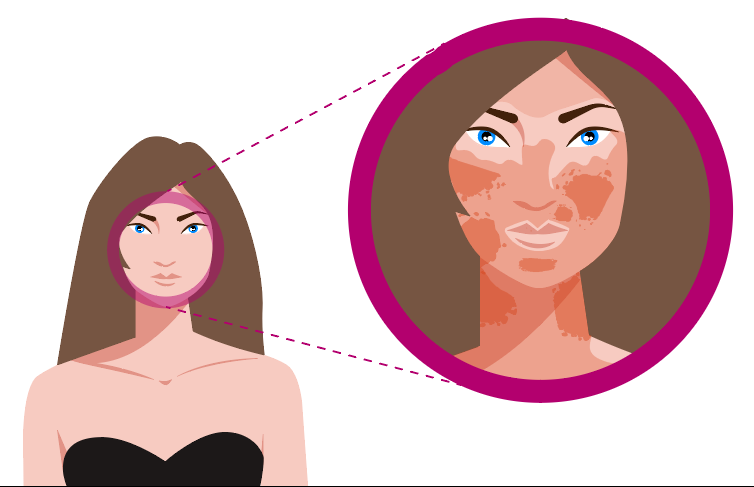 Grafika przedstawia kobietę wraz ze zbliżeniem na twarz. Skóra twarzy jest zaczerwieniona w wyniku otarć naskórka po głowicy do mikrodermablazji.