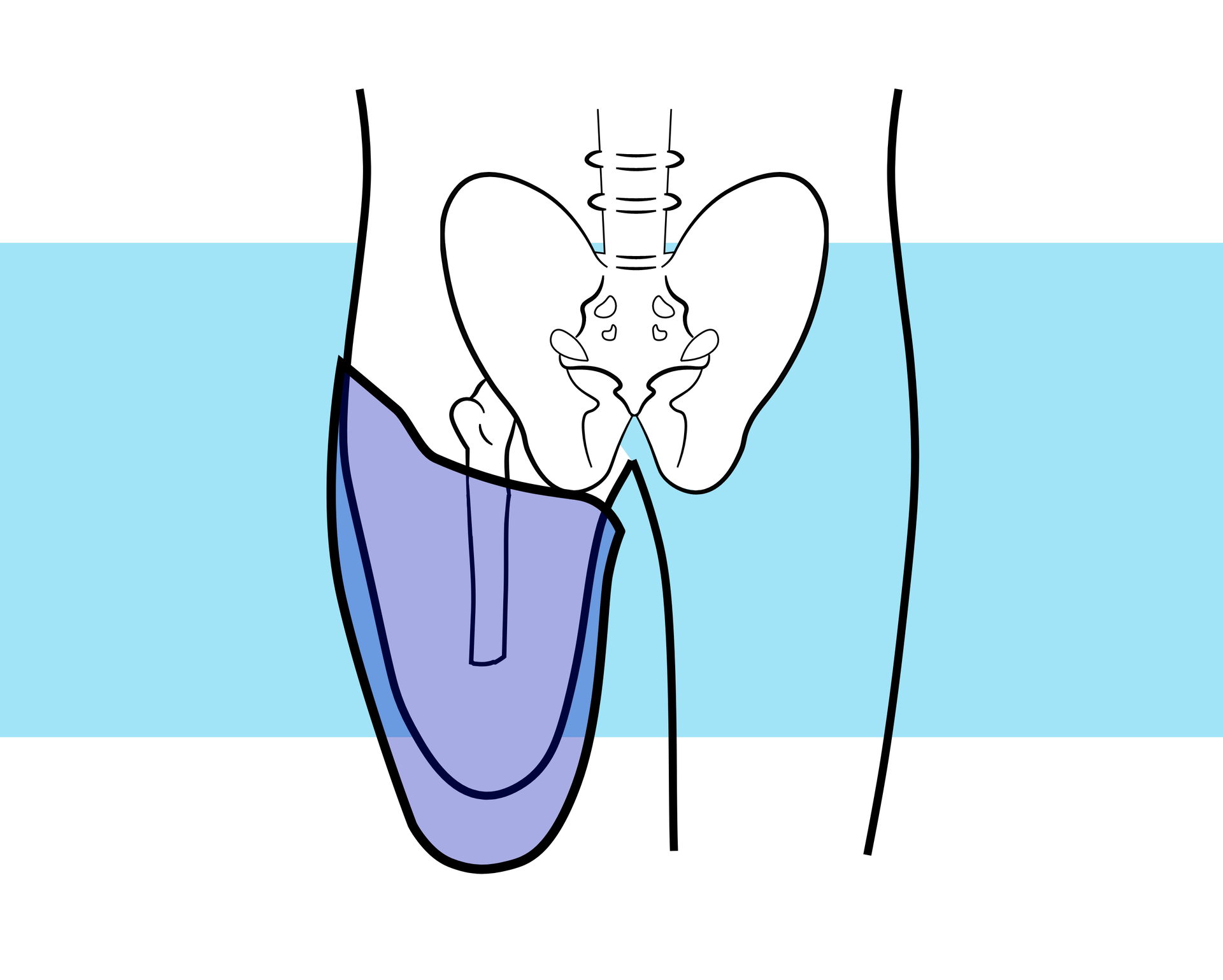 Grafika przedstawia schemat kończyn dolnych wraz ze szkieletem. Jedna z kończyn to kikut. Na rycinie zaznaczono również położenie leja obejmującego kikut.