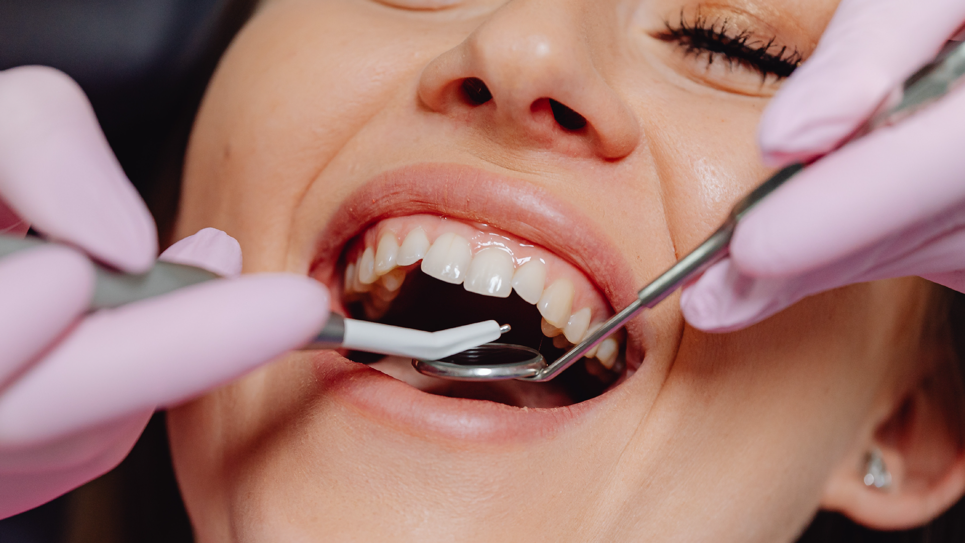 Zdjęcie przedstawia zbliżenie na twarz osoby u dentysty. Osoba ma otwarte usta. Widoczne są także ręce dentysty i przyrządy dentystyczne, które wkłada pacjentowi do ust i przegląda zęby.