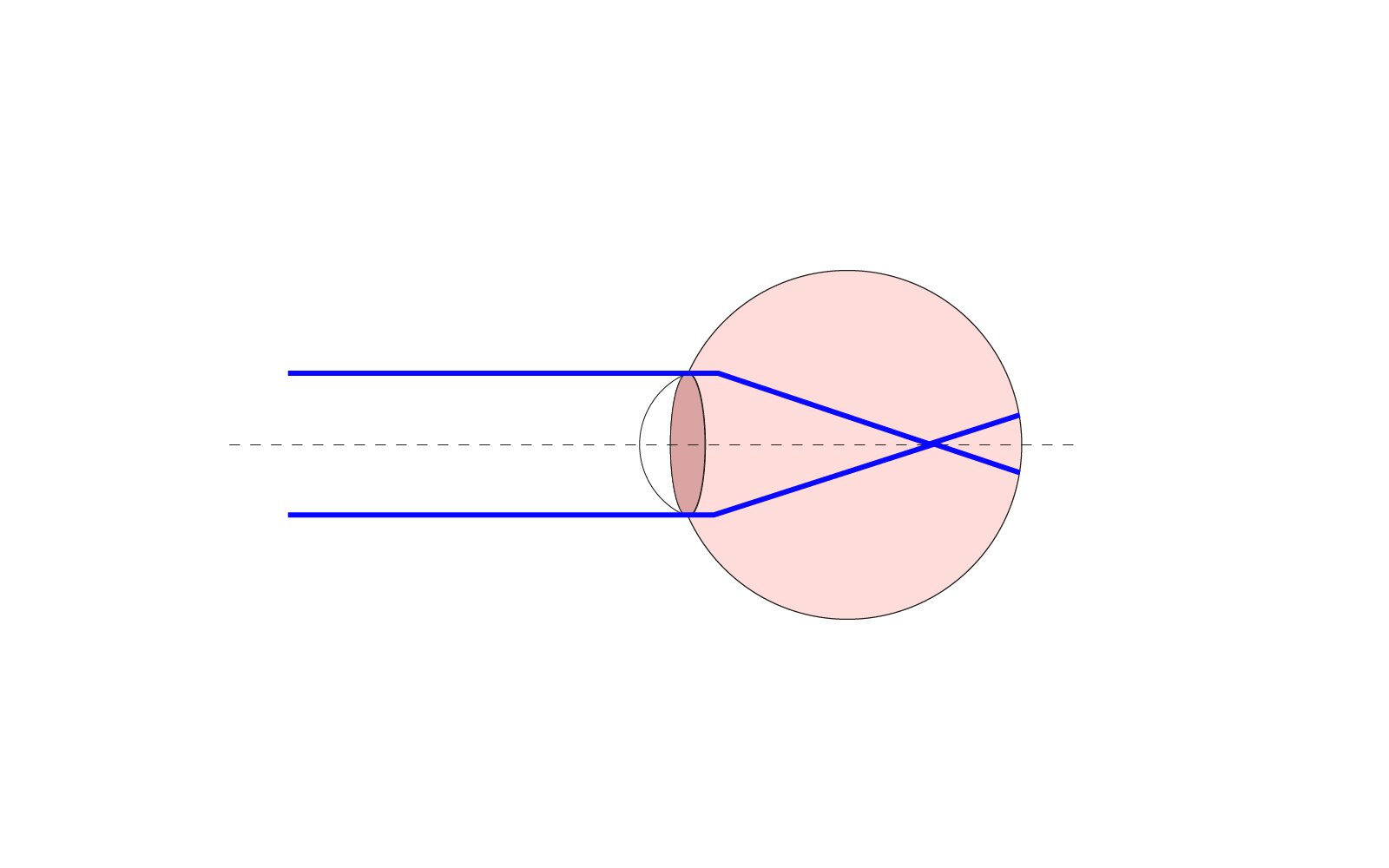 Ilustracja przedstawia krótkowzroczność oka pokazane jest oko oraz nieprawidłowe ogniskowanie światła na siatkówce oka. Obraz dwa razy się obraca.