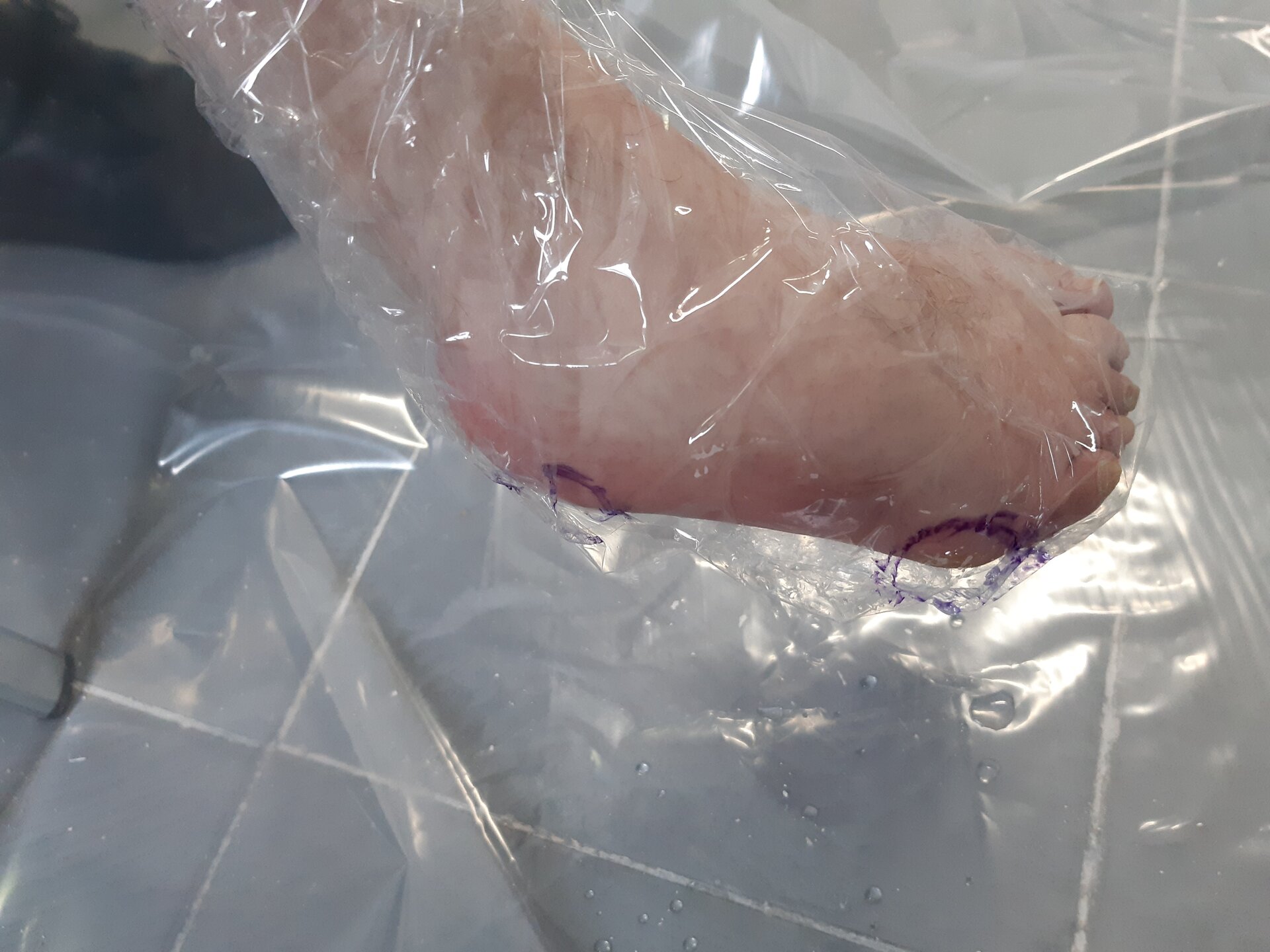 Zdjęcie przedstawia zniekształconą stopę, która owinięta jest folią i oznaczona okręgami w bolesnych miejscach.