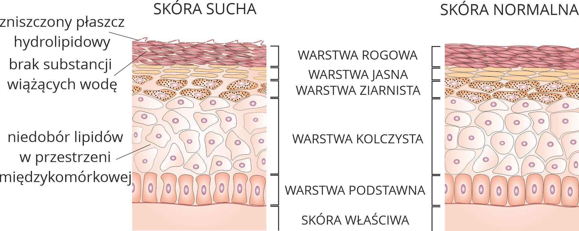 Grafika przedstawia schematyczny przekrój naskórka skóry suchej i normalnej. Naskórek składa się z kilku warstw. Warstwą wierzchnią jest warstwa rogowa, zbudowana z podłużnych, płasko ułożonych komórek. W przypadku skóry suchej płaszcz hydrolipidowy tej warstwy jest zniszczony i nie ma w niej substancji wiążących wodę. Poniżej warstwy rogowej znajduje się warstwa jasna, złożona z owalnych, płasko położnych komórek. Pod nią jest warstwa ziarnista, którą tworzą różnokształtne komórki z ziarnistościami. Poniżej warstwy ziarnistej znajduje się warstwa kolczysta, złożona z różnokształtnych komórek z dużymi jądrami. Warstwa ta w przypadku skóry suchej charakteryzuje się niedoborem lipidów w przestrzeni międzykomórkowej. Pod warstwą kolczystą jest warstwa podstawna, zbudowana z prostokątnych komórek z dużymi jądrami. Poniżej warstw naskórka znajduje się skóra właściwa.