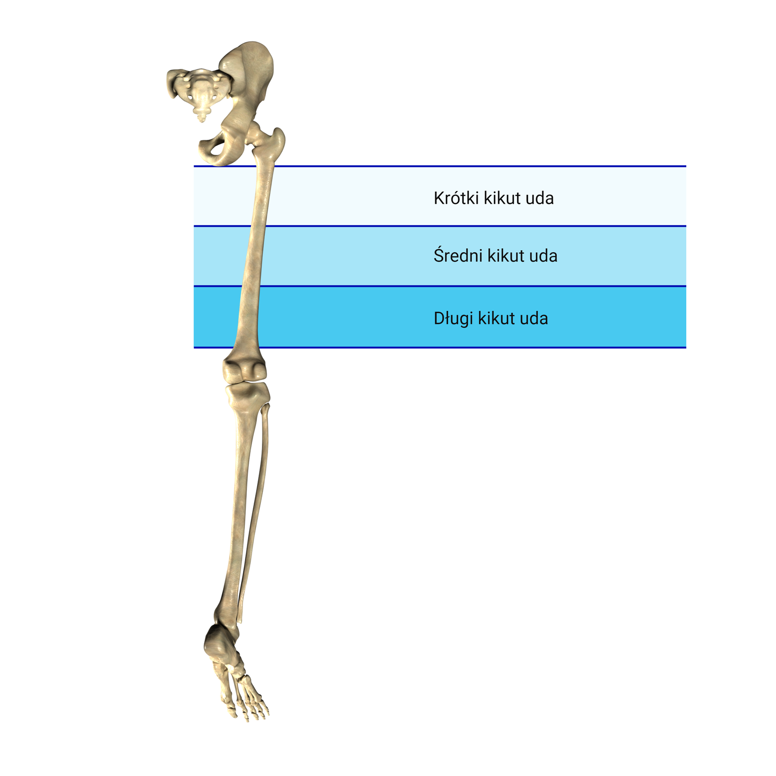 Grafika przedstawia szkielet kończyny dolnej. Na rycinie zaznaczono odcinki amputacji skutkującej powstaniem krótkiego, średniego i długiego kikuta uda, dotyczącej odpowiednio bliższej jednej trzeciej, środkowej jednej trzeciej i dalszej jednej trzeciej kości udowej.