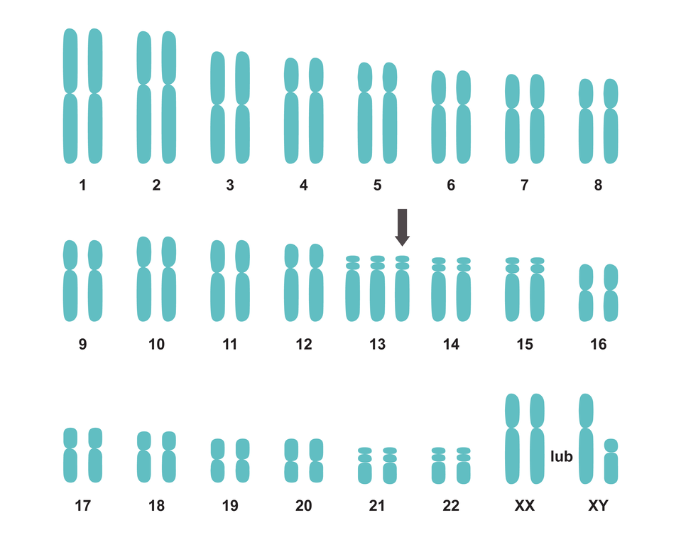 Ilustracja przedstawia kariotyp osoby z zespołem Patau. Na ilustracji 23 pary chromosomów różnej wielkości. W 13 parze znajdują się trzy chromosomy zamiast dwóch. Ostatnia para chromosomów to chromosomy XX (żeńskie) oraz XY (żeński i męski), które warunkują płeć. 