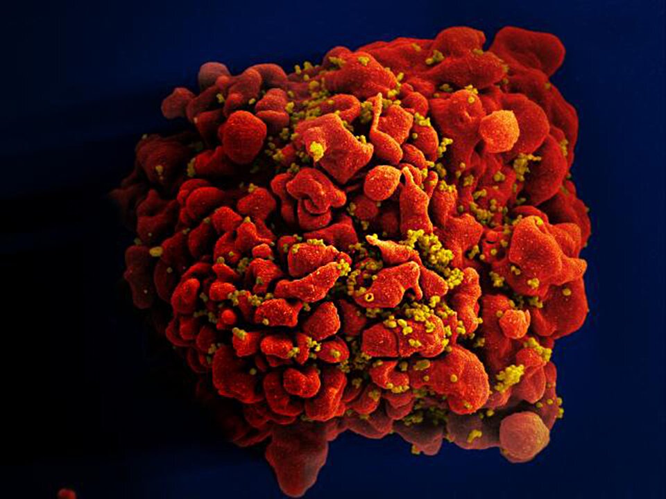 Zdjęcie z mikroskopu skaningowego przedstawia ludzki limfocyt T zainfekowany wirusem HIV. Limfocyt składa się z wielu czerwonych, pofałdowanych części. Na jego powierzchni znajdują się żółte, niewielkie punkty.