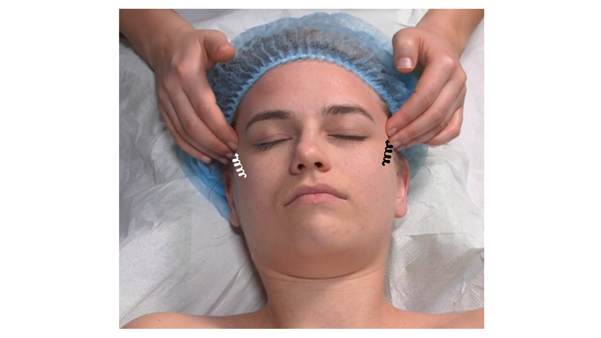 Zdjęcie przedstawia twarz pacjenta w leżeniu tyłem. Głowa pacjenta spoczywa na poduszce. Masażysta znajduje się za głową pacjenta i wykonuje okrężny ruch opuszkami trzeciego palca obu rąk, kierując się od wewnętrznych kącików oczu w stronę skroni, okalając ruchem oczy.