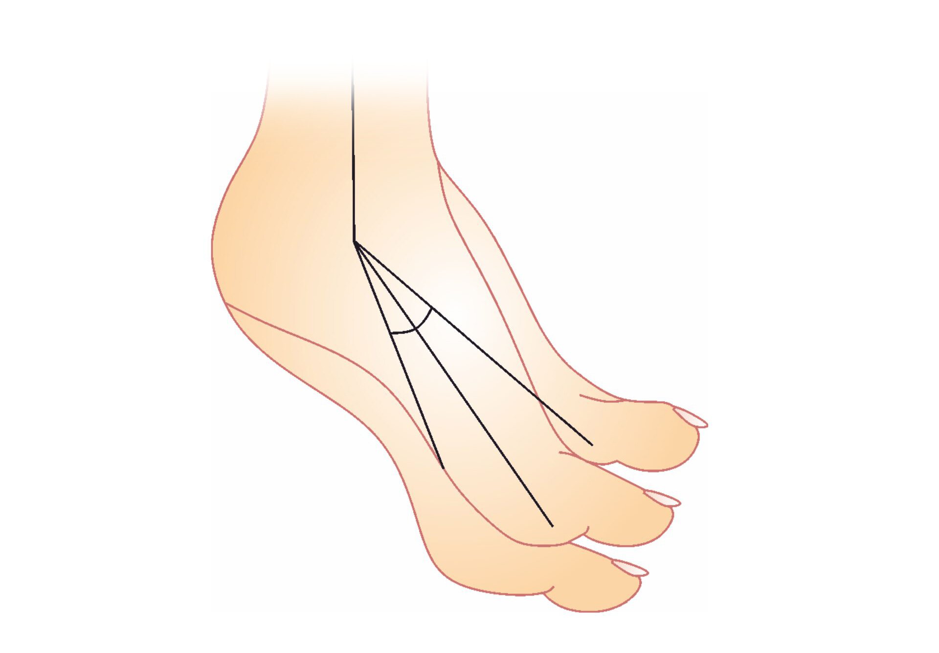 Grafika przedstawiająca stopę opadającą. Stopa jest wyprostowana w nienaturalny sposób, z palcami skierowanymi w stronę podłoża i uniesioną piętą. 